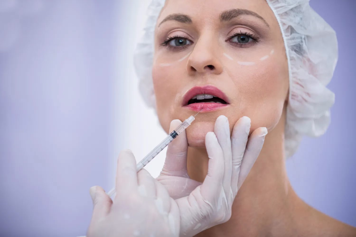 De ce alegem buze cu acid hialuronic
