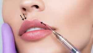 Cum decurge procedura Russian Lips