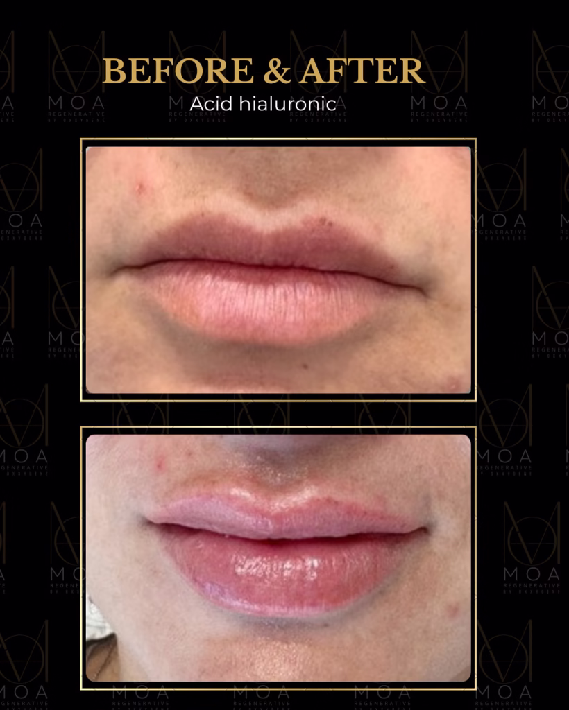 before&after procedura cu acid hialuronic la MOA Clinic - pacient nr. 3